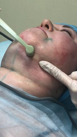 Проведение процедуры FaceTite Проведение процедуры FaceTite, фото