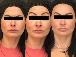 Инъекции Диспорт