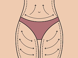 Нитевой лифтинг живота и тела