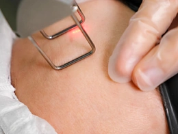 Удаление келоидных рубцов лазером